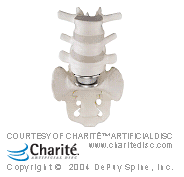 charite artificial disc surgery for lumbar and cervical spine - georgia spine center