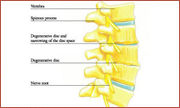 Degenerative Disc