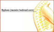 Kyphosis