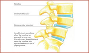 Spondylolsis